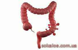 дивертикулез